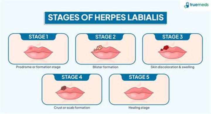 Exploring the Possibilities: Is a Herpes Cure Within Reach?