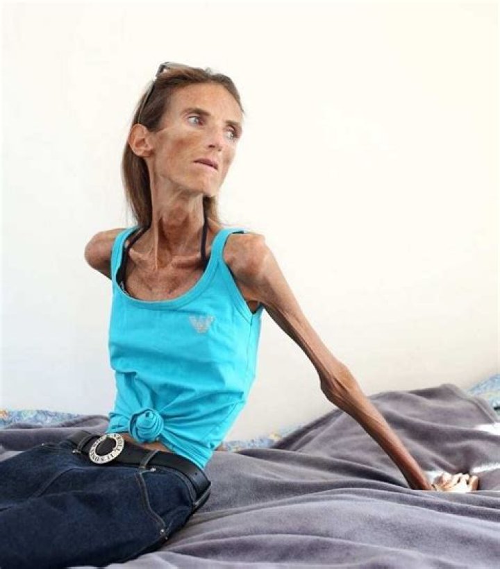 Who's the World's Skinniest Man? Discover the Remarkable Story